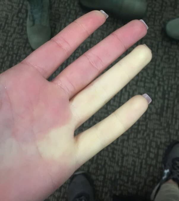 Sindrom Raynaud