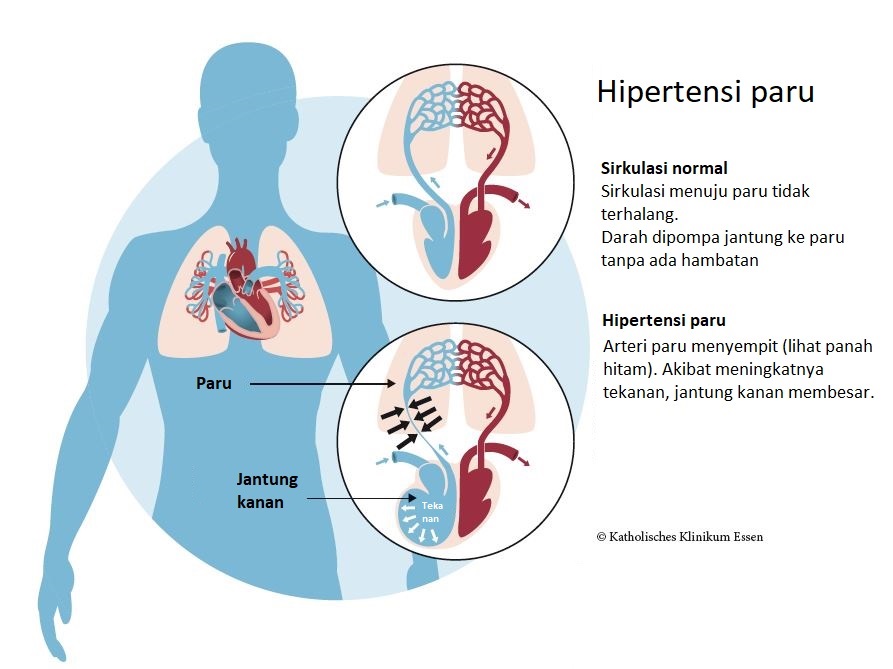 Hipertensi paru Hipertensi paru