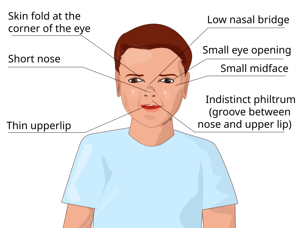 Gangguan spektrum alkohol di janin Gangguan spektrum alkohol di janin