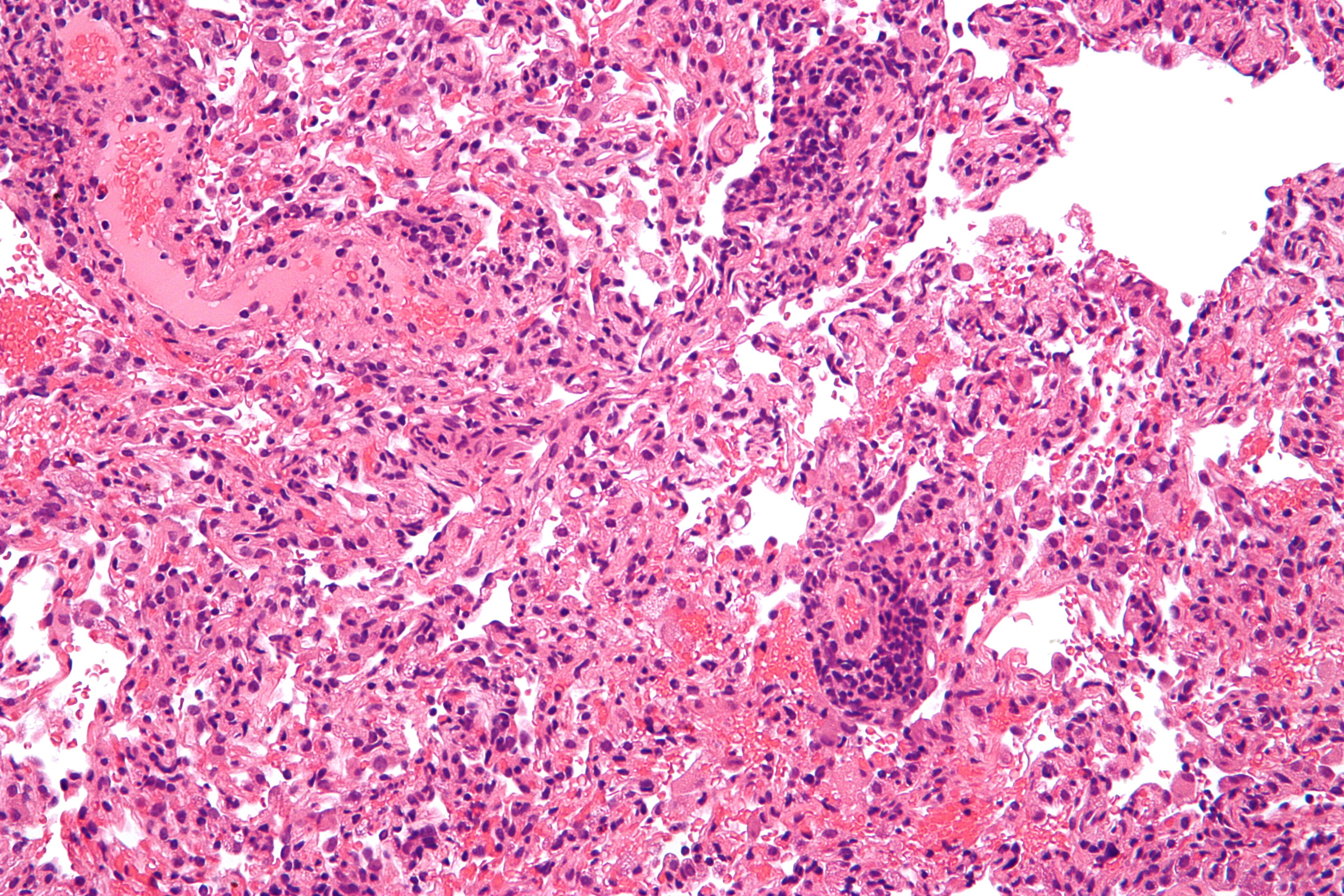 Penolakan transplantasi Penolakan transplantasi